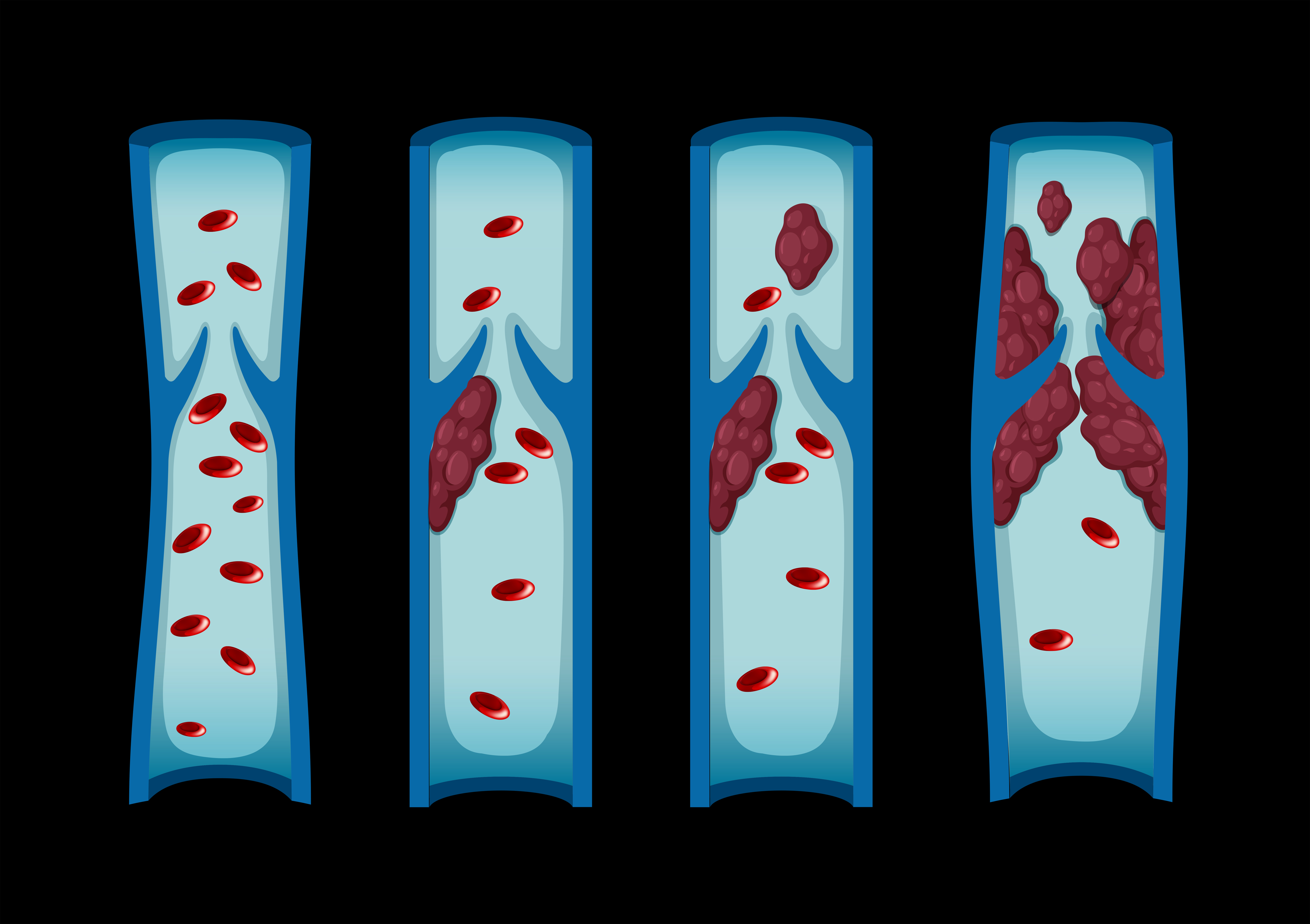 Different stages of blood clot in human 297245 Vector Art at Vecteezy
