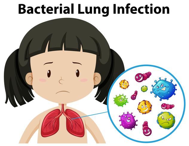 Un vector de infección pulmonar bacteriana