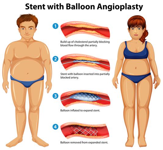 Stent con balón de angioplastia vector