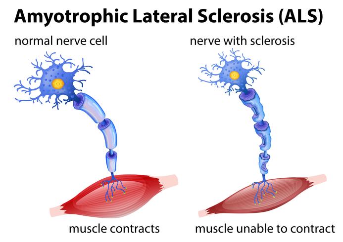 Amyotrophic lateral sclerosis concept vector