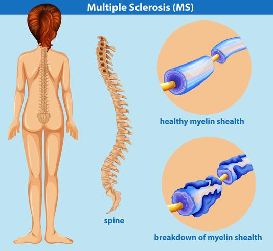 An Education Poster of Sclerosis vector