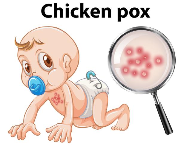 A Baby with Chicken Pox vector