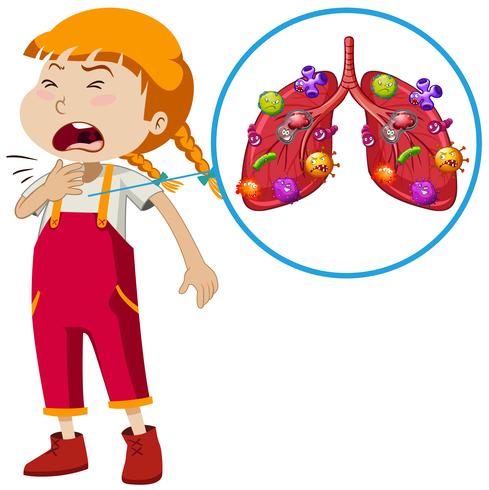 Un vector de infección pulmonar de niña