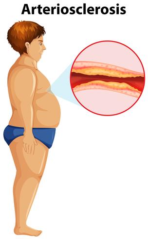 An Overweight Man with Arteriosclerosis - Download Free Vector Art, Stock Graphics & Images