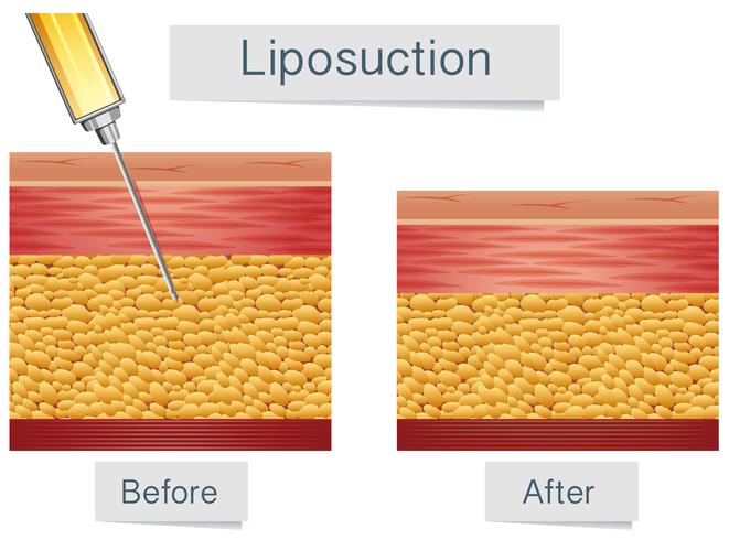 Tratamiento médico y comparación de liposucción vector