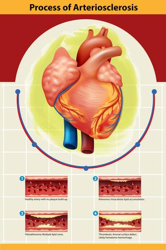 Poster of Arteriosclerosis process  vector