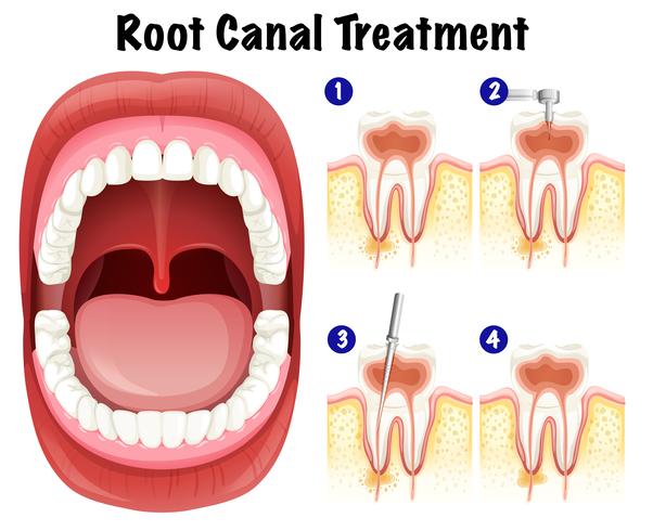 Dental Vector of Root Canal Treatment