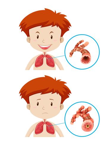 Chicos con pulmones sanos y enfermos. vector