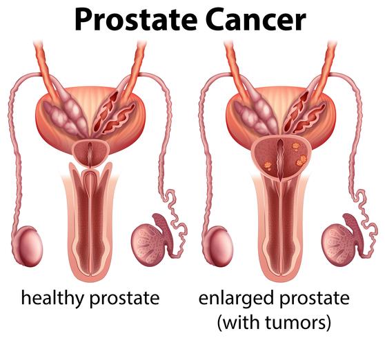 Comparación de salud y cáncer de próstata vector