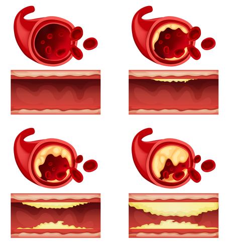 Diagrama que muestra el coágulo de sangre vector