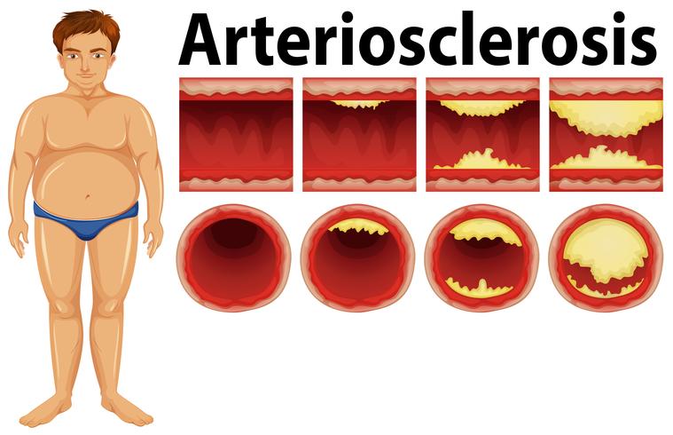 Un hombre gordo con aterosclerosis. vector