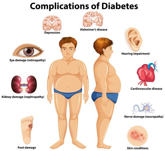 Complicaciones del concepto de diabetes. vector