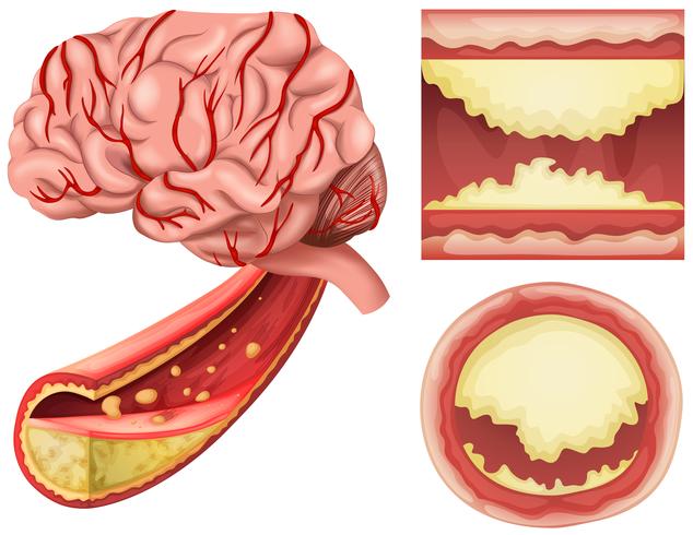 Una condición cerebral sobre fondo blanco vector