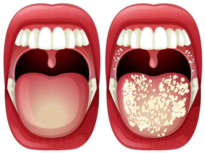 Vector of Healthy and Virus Mouth