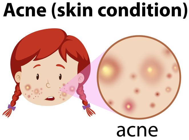 A Young Girl Having Acne vector