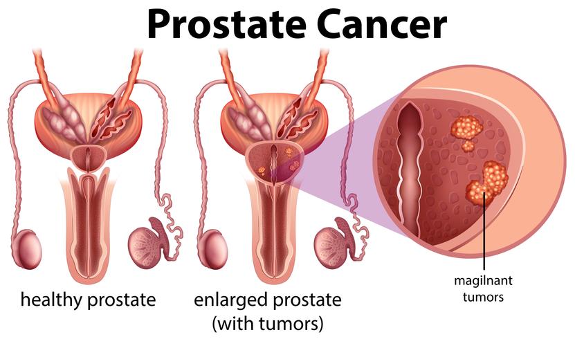 Cáncer de próstata sobre fondo blanco vector