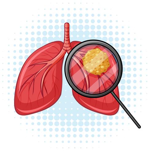 Cancer in human lungs vector