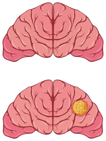 Cerebro humano con cancer vector