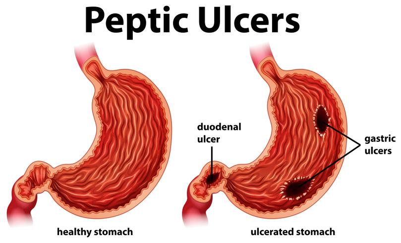 Diagram showing peptic ulcers vector