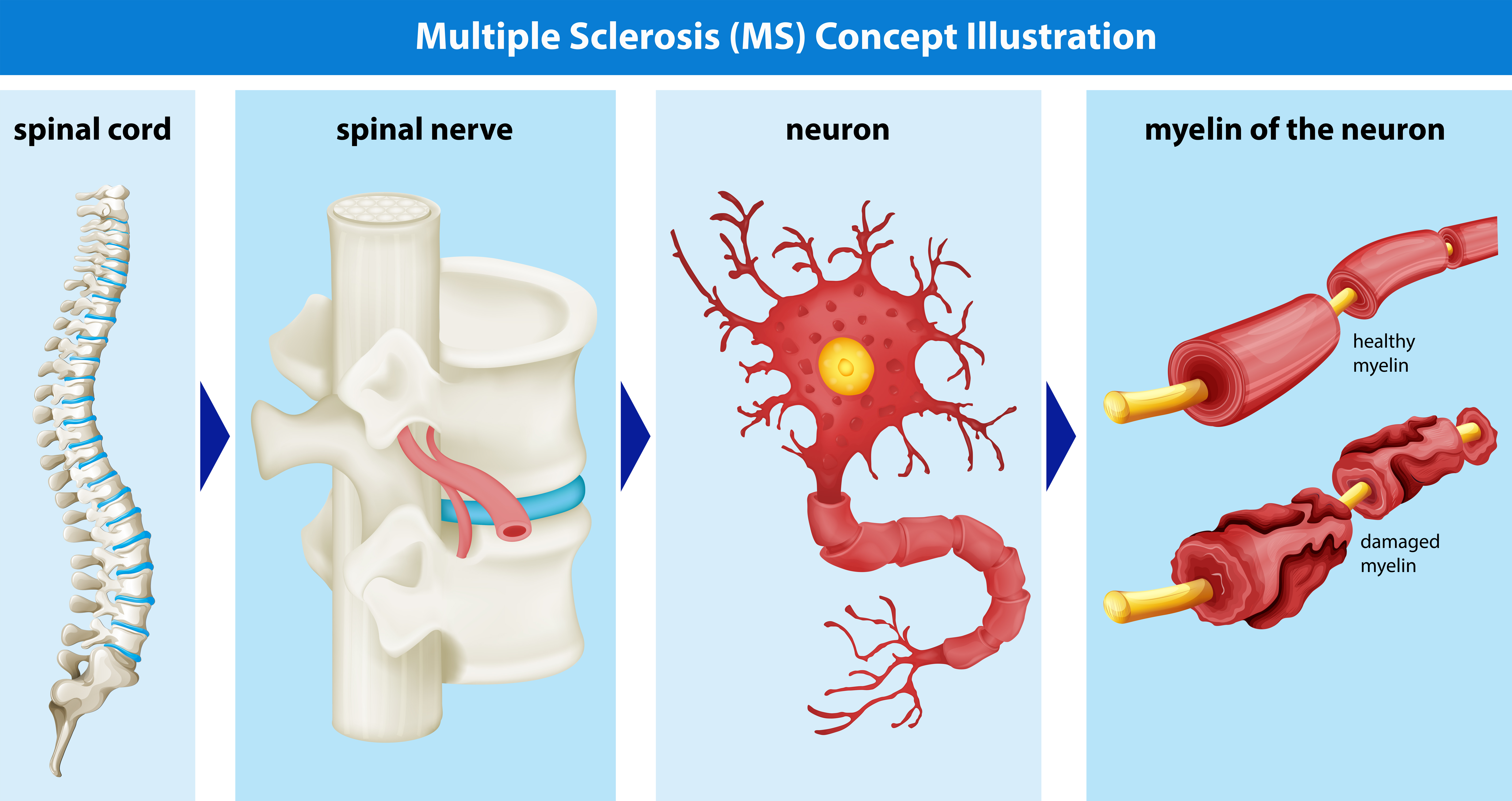 Multiple Sclerosis Animation