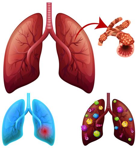 Un conjunto de condiciones pulmonares vector