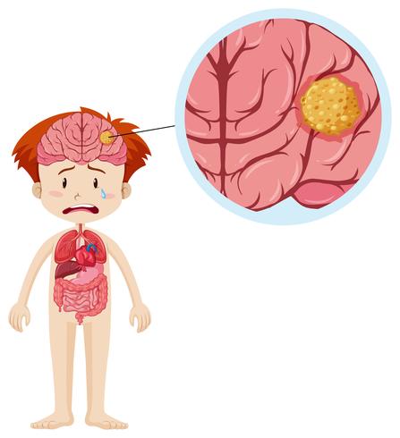 Little boy and brain cancer vector