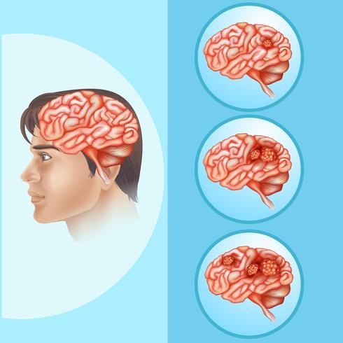 Diagram showing brain cancer in human vector