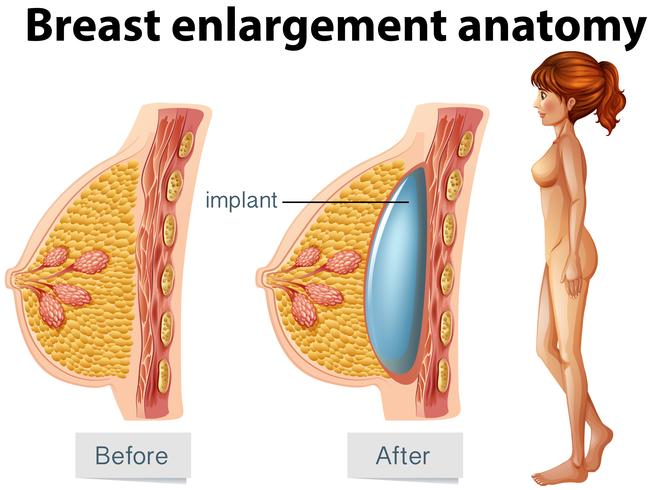 A Human Anatomy of Breast Implant vector