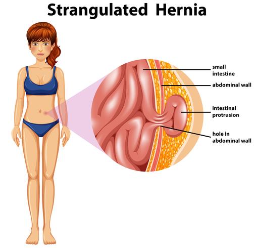 Woman Strangulated Hernia Diagram vector