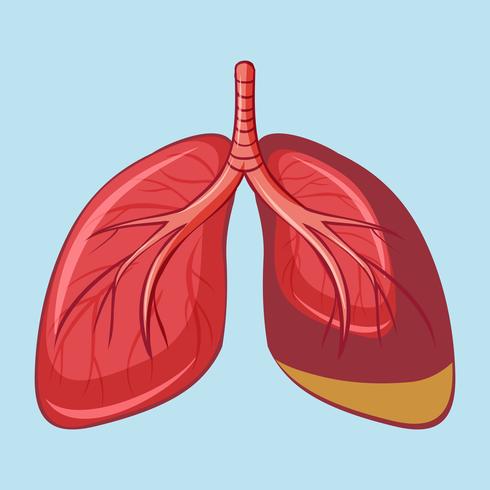 Pulmón humano con mesotelioma pleural vector