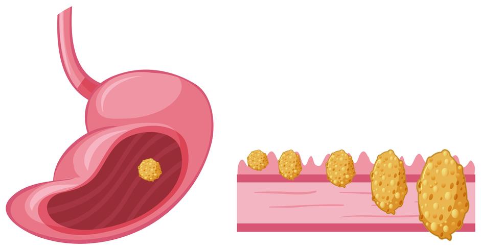 Cáncer en estómago humano vector