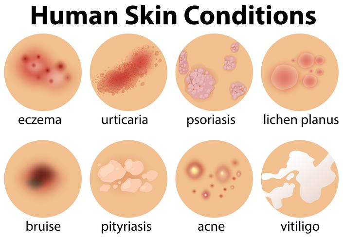 Un conjunto de condiciones de la piel humana vector