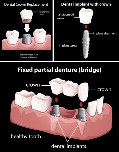 Procedimientos dentales en negro vector