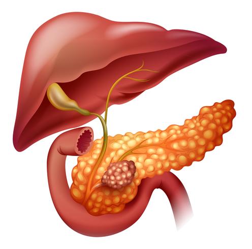 Pancreas cancer diagram on white vector