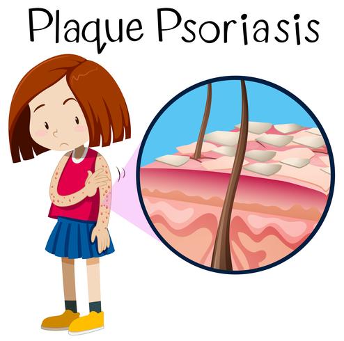 Un vector de psoriasis en placa de niña