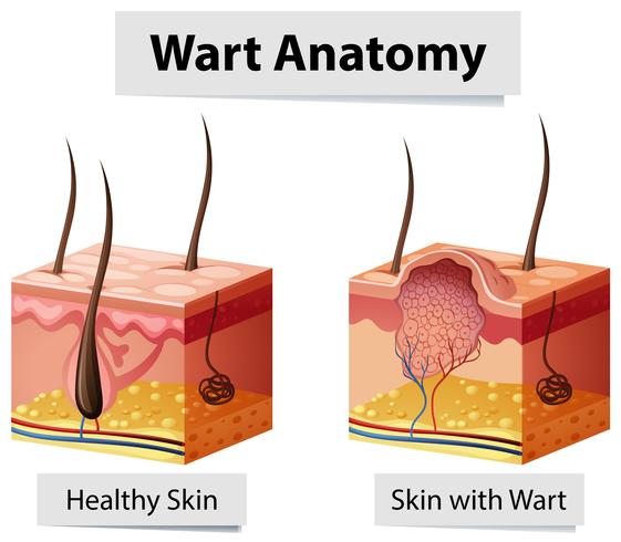 Ilustración de anatomía de piel humana de verruga vector