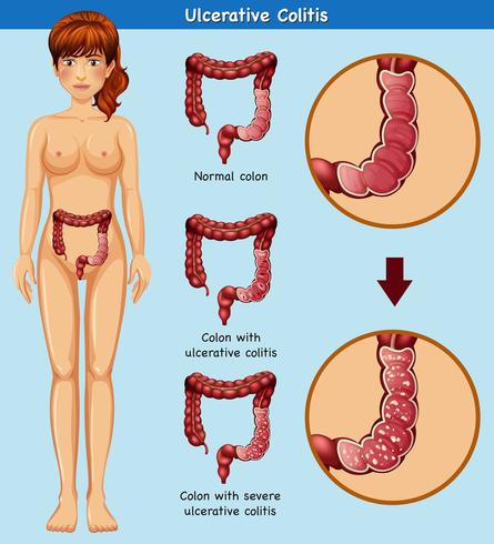 Human Anatomy of Ulcerative Colitis vector