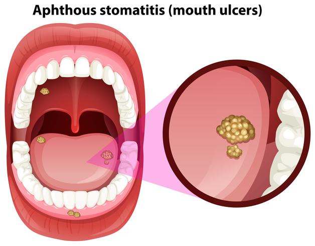 Anatomía humana de la boca de las úlceras. vector