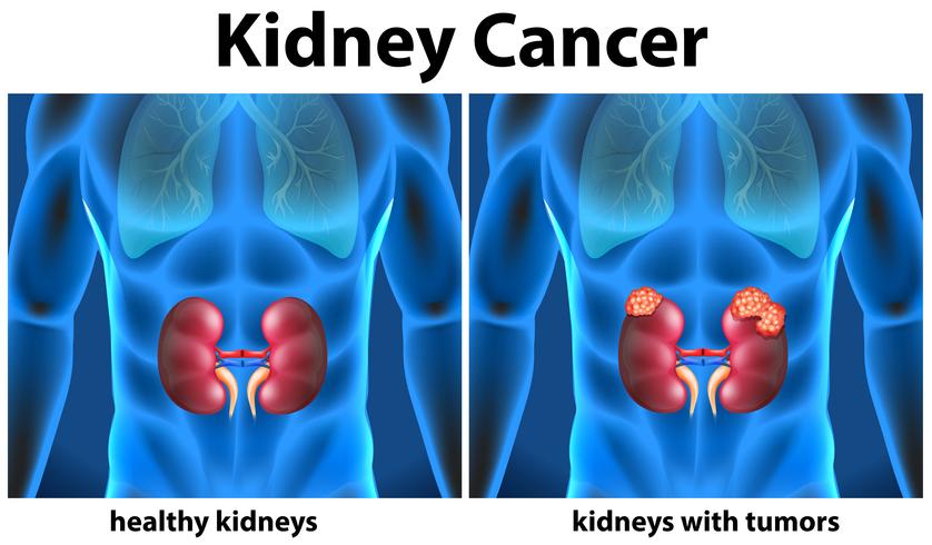 Diagram showing kidney cancer in human vector