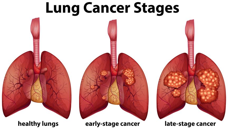 Diagram Showing Lung Cancer Stages 301312 Vector Art At Vecteezy