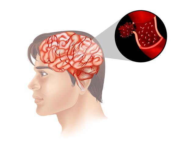 Cáncer de cerebro en humanos vector