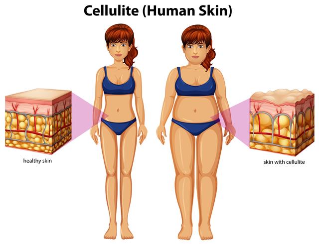 Una comparación de mujeres con celulitis vector