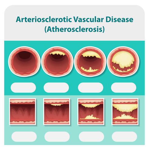 Diagram showing arteriosclerotic veascular disease vector