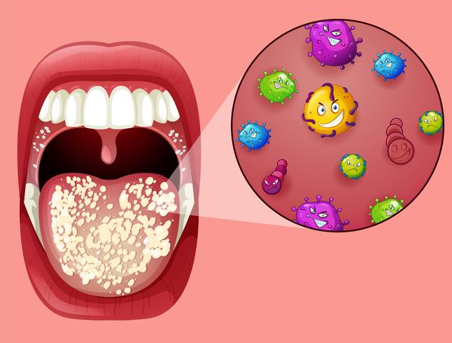 Human Mouth with Oral Thrush vector