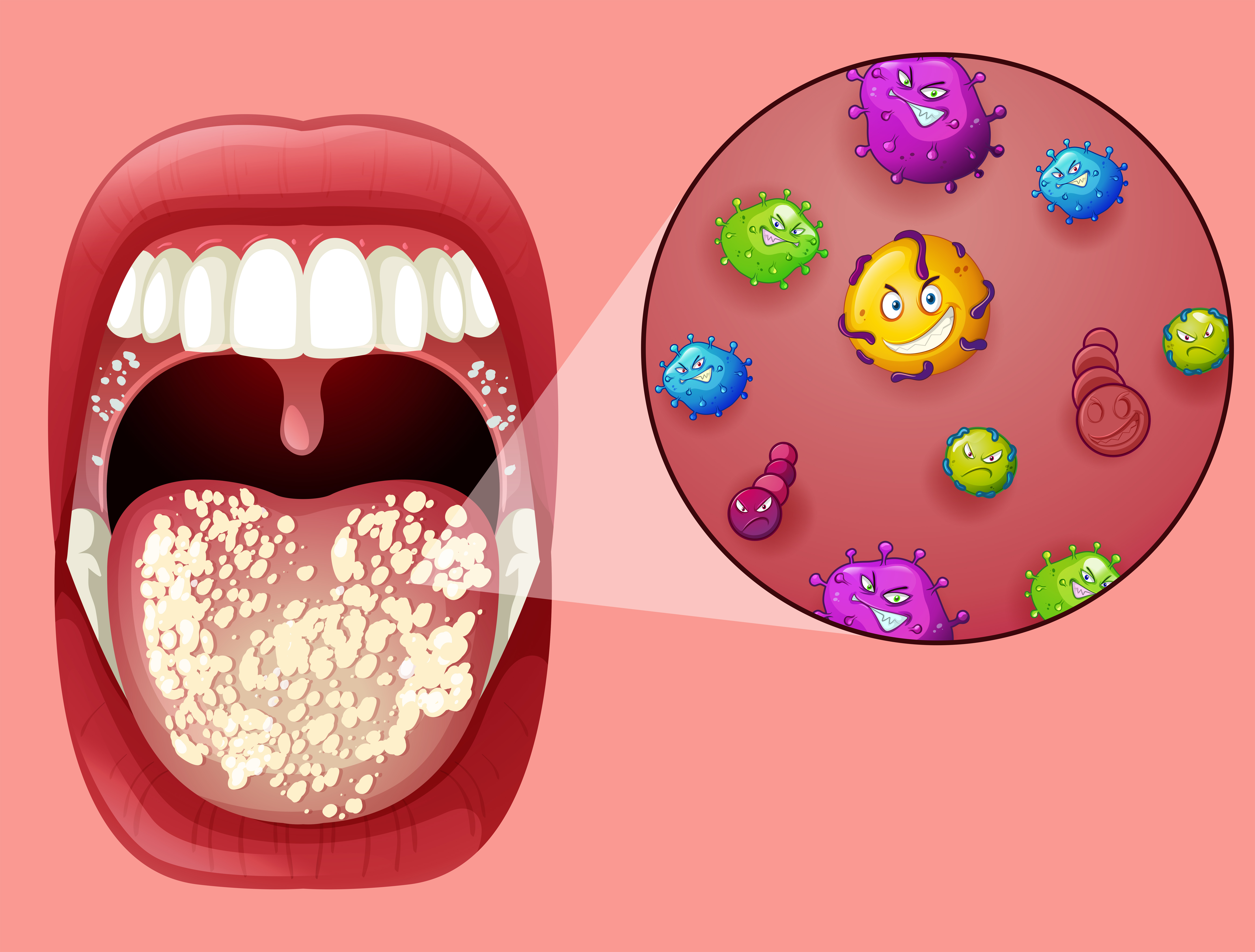 Human Mouth with Oral Thrush 301558 Vector Art at Vecteezy