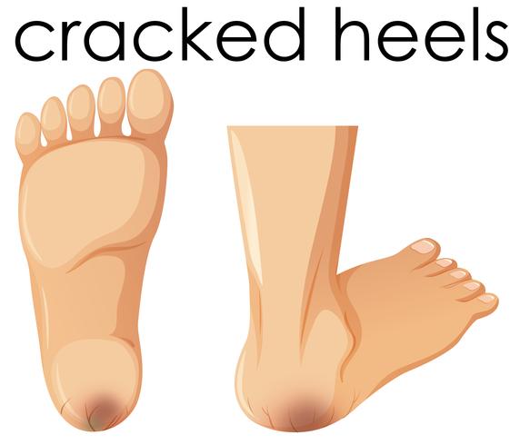 A Set of Human Foot with Cracked Heels vector