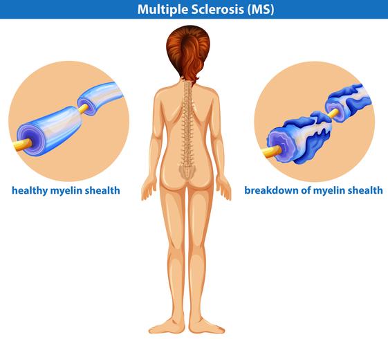 Un vector médico de esclerosis múltiple