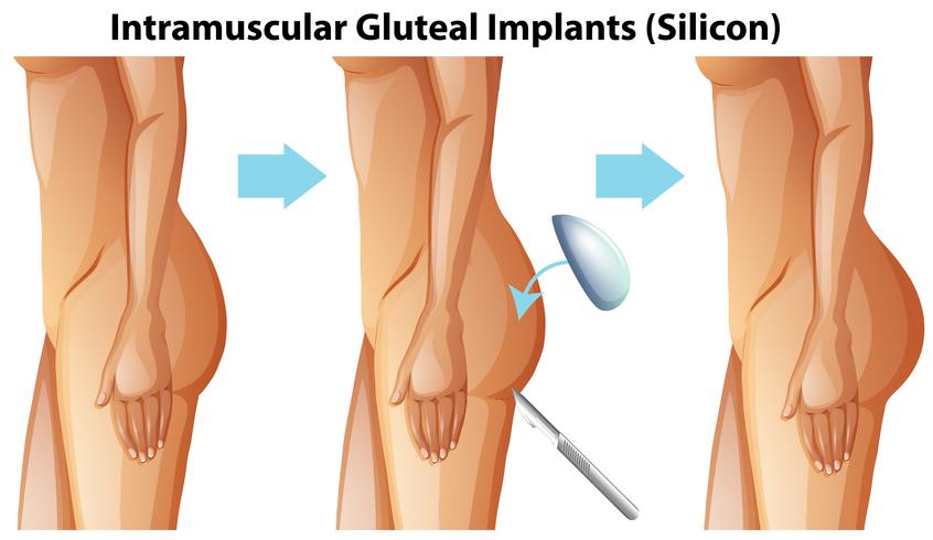 Implantes de glúteos intramusculares sobre fondo blanco vector