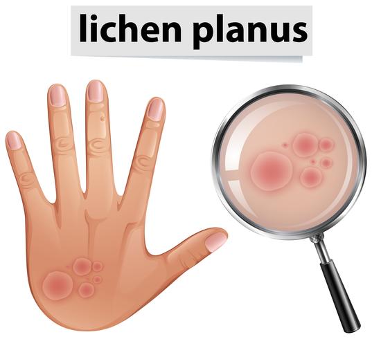 A Human Skin Problem Lichen Planus vector