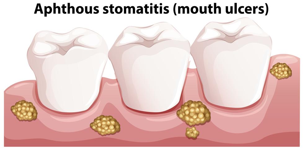 Anatomía humana de la estomatitis aftosa vector